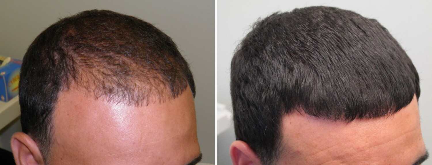 v71mm53dpt9rxepp.D.0.Hair-Loss-Treatment.jpg